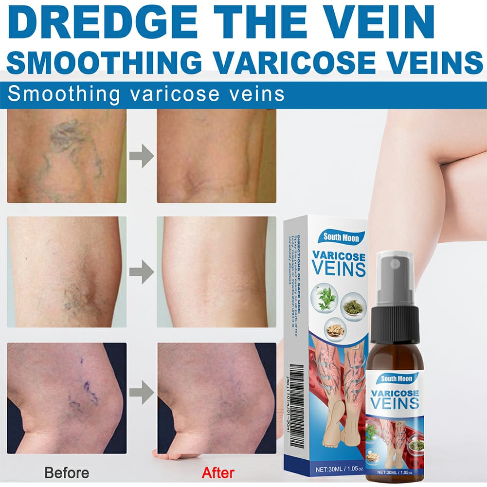 Varicose Veins Treatment Spray